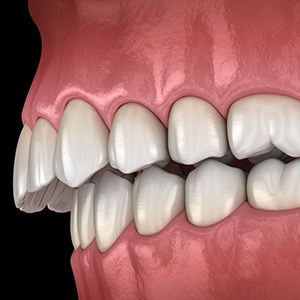 Illustration of an overbite