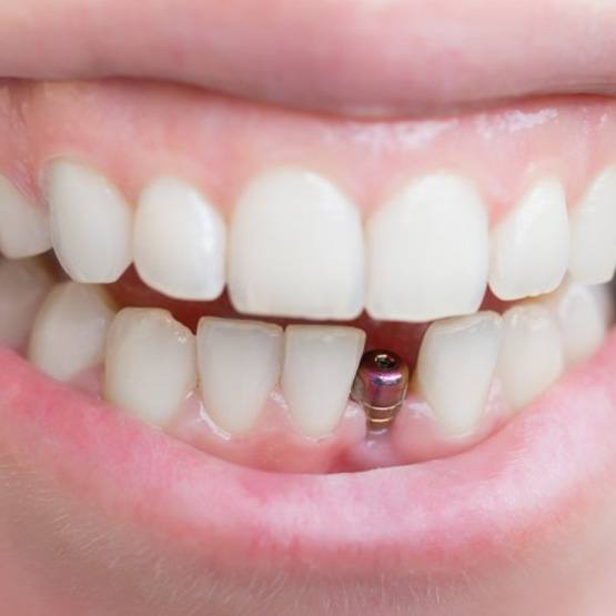 Smile with dental implant
