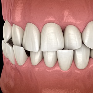 Illustration of a crossbite