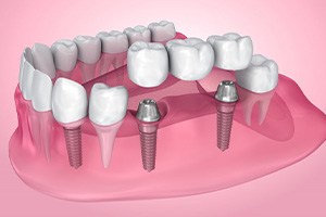 Exploded illustration of dental implants with bridge