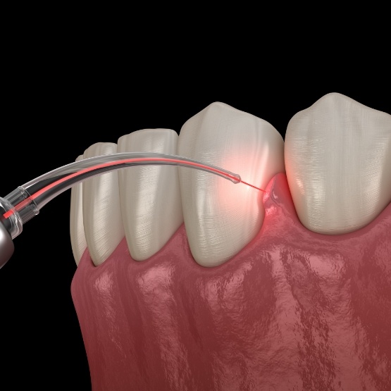 Illustrated dental laser treating the gums