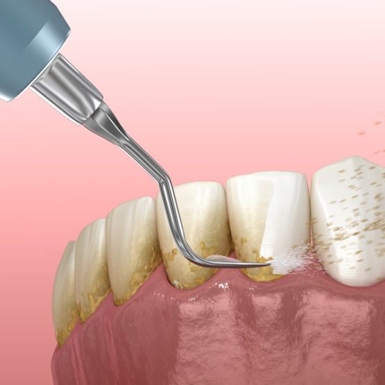 Illustrated dental scaler clearing plaque buildup from teeth and gums