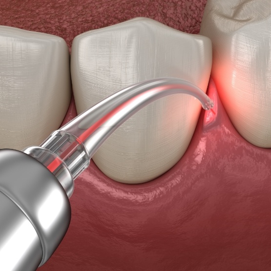 Illustrated dental laser treating gum disease