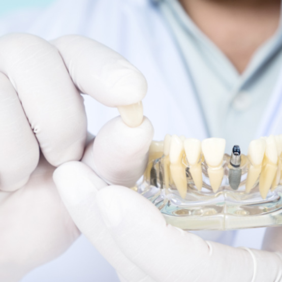 Dentist wearing white coat and gloves holding crown of sample dental implant