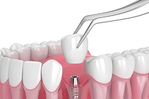 Illustration of single dental implant