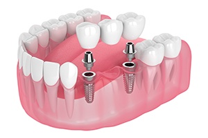 Illustration of implant bridge