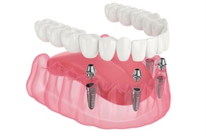 Illustration of implant denture