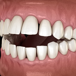 Example of an open bite fixable with Invisalign in Albuquerque