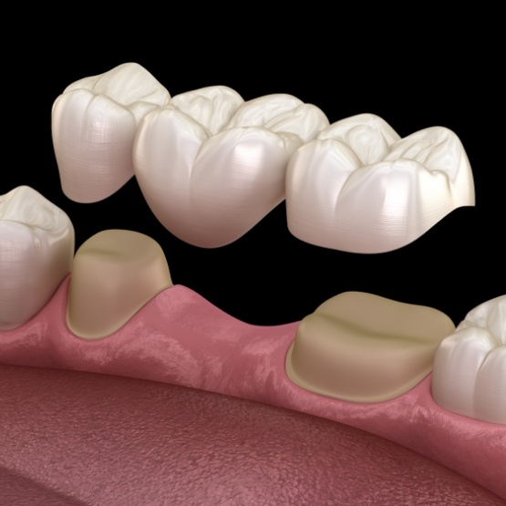Illustrated dental bridge replacing a missing tooth