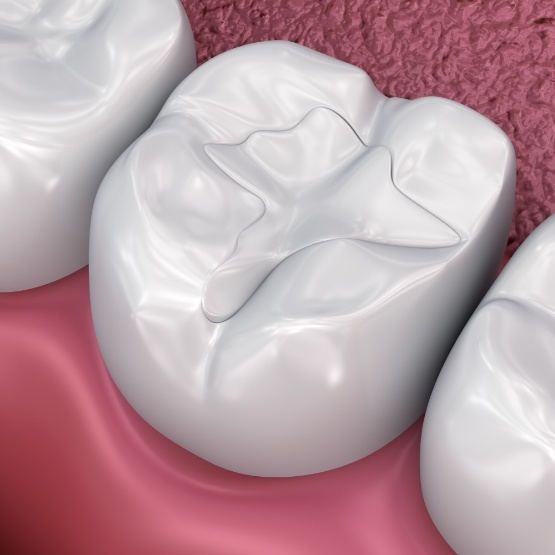 Illustrated tooth with a white filling