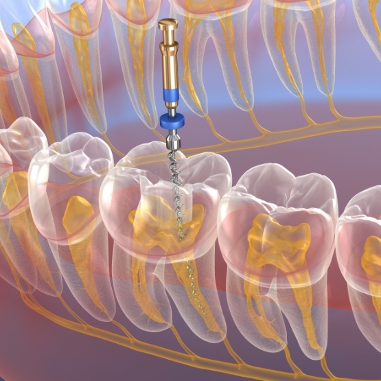 Illustrated dental instrument treating inside of tooth