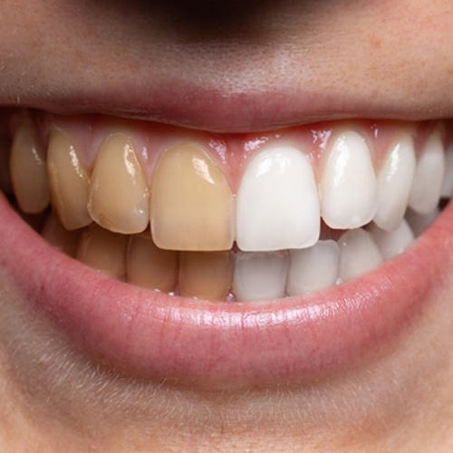 Side-by-side image of stained and whiter teeth