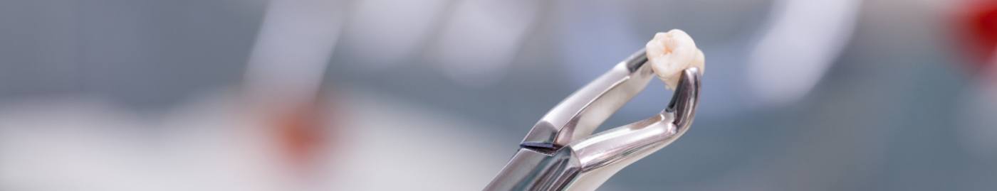 Dental clasps holding a tooth after wisdom tooth extractions in Albuquerque