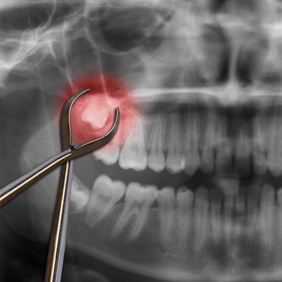 Forceps in front of dental x ray showing impacted wisdom teeth
