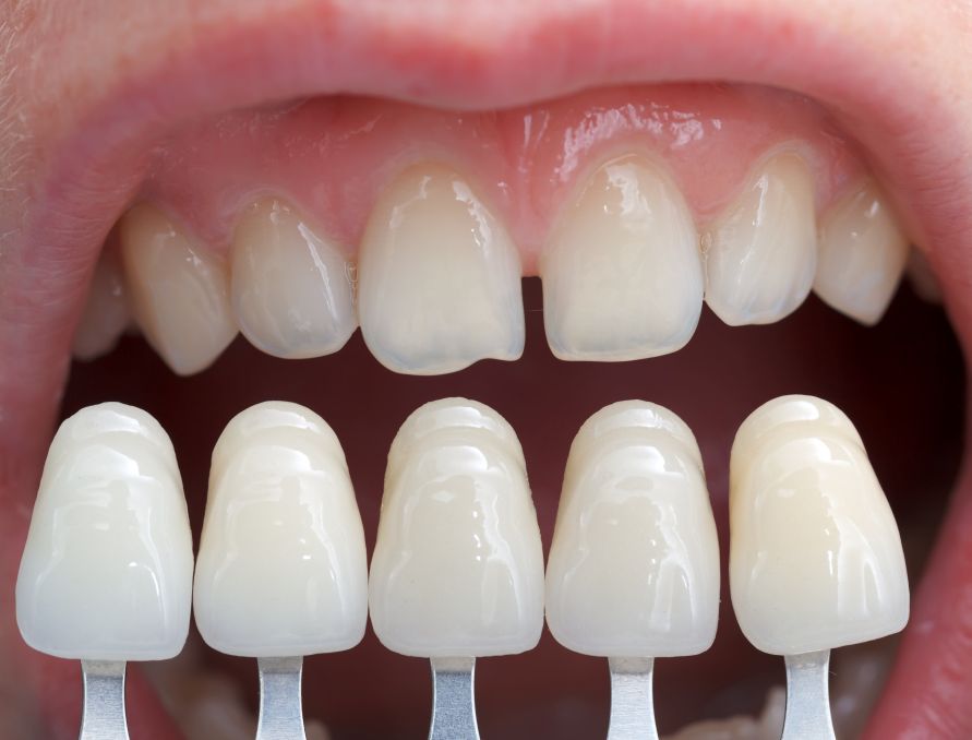 A woman with gaps in her smile