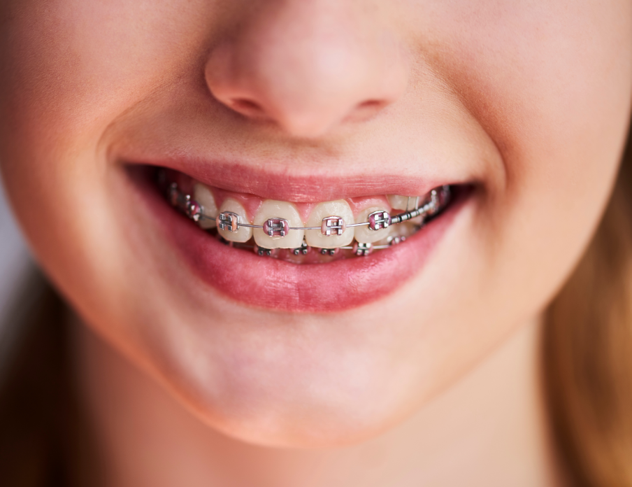 Girl with pink braces