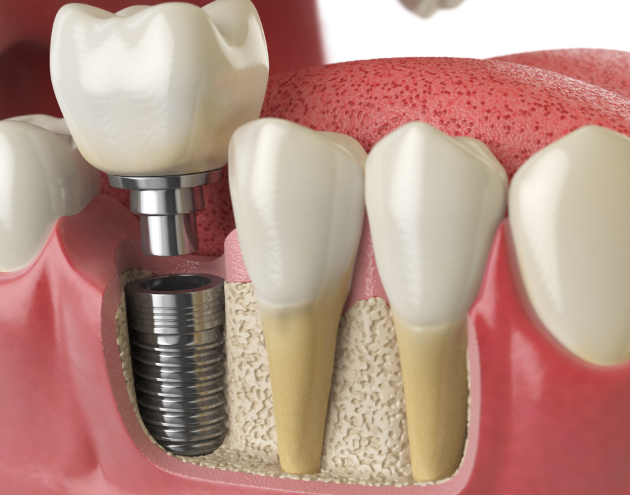 3D image of dental implants
